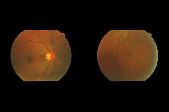 Retina Eye Specialist In Indore